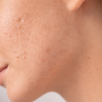 Behandling for aknearr hos Zenya Estetisk Klinikk Bergen