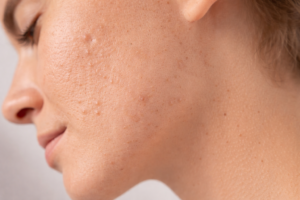 Behandling for aknearr hos Zenya Estetisk Klinikk Bergen